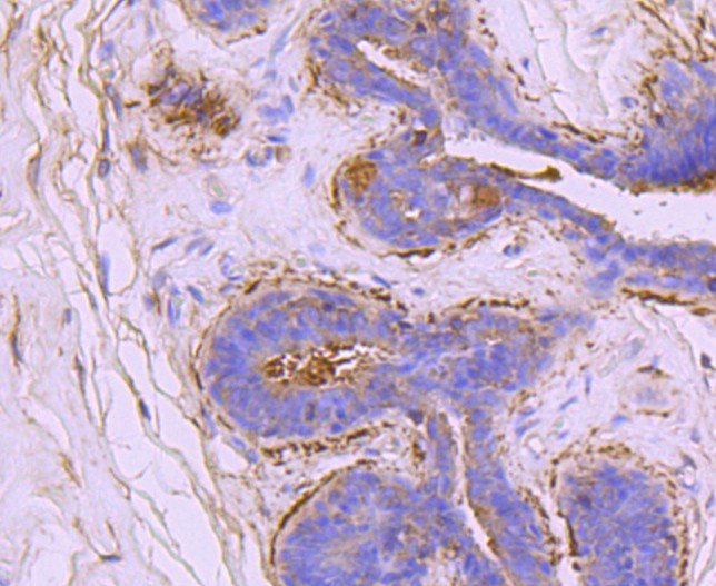 Immunohistochemical analysis of paraffin-embedded human breast carcinoma tissue using anti-Ezrin antibody. The section was pre-treated using heat mediated antigen retrieval with Tris-EDTA buffer (pH 8.0-8.4) for 20 minutes.The tissues were blocked in 5% BSA for 30 minutes at room temperature, washed with ddH2O and PBS, and then probed with the primary antibody (ET1703-25, 1/50) for 30 minutes at room temperature. The detection was performed using an HRP conjugated compact polymer system. DAB was used as the chromogen. Tissues were counterstained with hematoxylin and mounted with DPX.