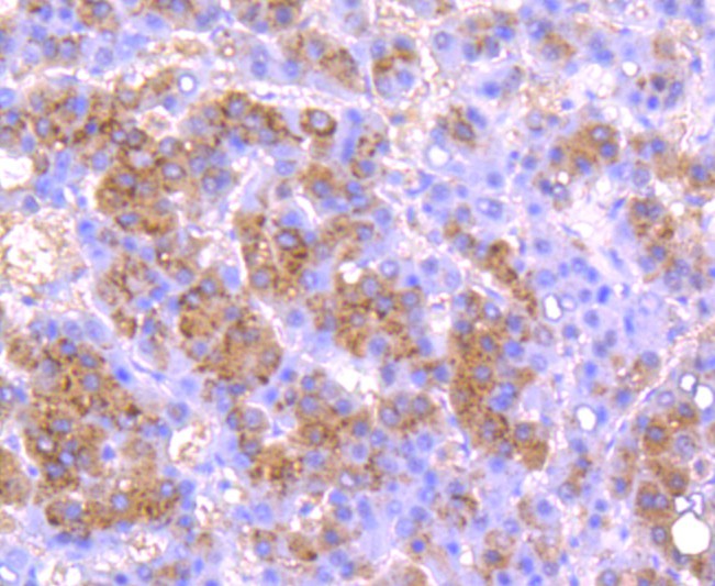 Immunohistochemical analysis of paraffin-embedded human liver carcinoma tissue using anti-Urokinase antibody. The section was pre-treated using heat mediated antigen retrieval with Tris-EDTA buffer (pH 8.0-8.4) for 20 minutes.The tissues were blocked in 5% BSA for 30 minutes at room temperature, washed with ddH2O and PBS, and then probed with the primary antibody (ET1703-26, 1/50) for 30 minutes at room temperature. The detection was performed using an HRP conjugated compact polymer system. DAB was used as the chromogen. Tissues were counterstained with hematoxylin and mounted with DPX.