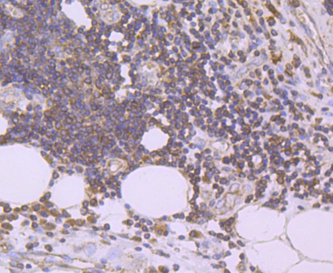 Immunohistochemical analysis of paraffin-embedded human colon carcinoma tissue using anti-Urokinase antibody. The section was pre-treated using heat mediated antigen retrieval with Tris-EDTA buffer (pH 8.0-8.4) for 20 minutes.The tissues were blocked in 5% BSA for 30 minutes at room temperature, washed with ddH2O and PBS, and then probed with the primary antibody (ET1703-26, 1/50) for 30 minutes at room temperature. The detection was performed using an HRP conjugated compact polymer system. DAB was used as the chromogen. Tissues were counterstained with hematoxylin and mounted with DPX.