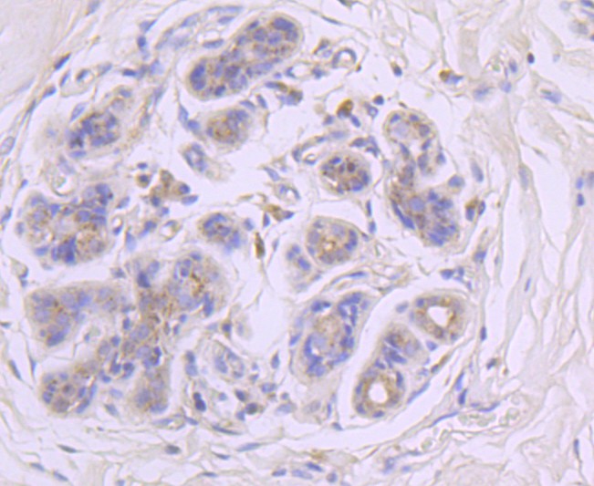 Immunohistochemical analysis of paraffin-embedded human breast carcinoma tissue using anti-GBA antibody. The section was pre-treated using heat mediated antigen retrieval with Tris-EDTA buffer (pH 8.0-8.4) for 20 minutes.The tissues were blocked in 5% BSA for 30 minutes at room temperature, washed with ddH2O and PBS, and then probed with the primary antibody (ET1703-32, 1/50) for 30 minutes at room temperature. The detection was performed using an HRP conjugated compact polymer system. DAB was used as the chromogen. Tissues were counterstained with hematoxylin and mounted with DPX.