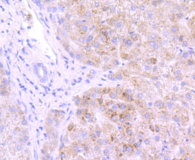 Immunohistochemical analysis of paraffin-embedded human liver tissue using anti-GBA antibody. The section was pre-treated using heat mediated antigen retrieval with Tris-EDTA buffer (pH 8.0-8.4) for 20 minutes.The tissues were blocked in 5% BSA for 30 minutes at room temperature, washed with ddH2O and PBS, and then probed with the primary antibody (ET1703-32, 1/50) for 30 minutes at room temperature. The detection was performed using an HRP conjugated compact polymer system. DAB was used as the chromogen. Tissues were counterstained with hematoxylin and mounted with DPX.