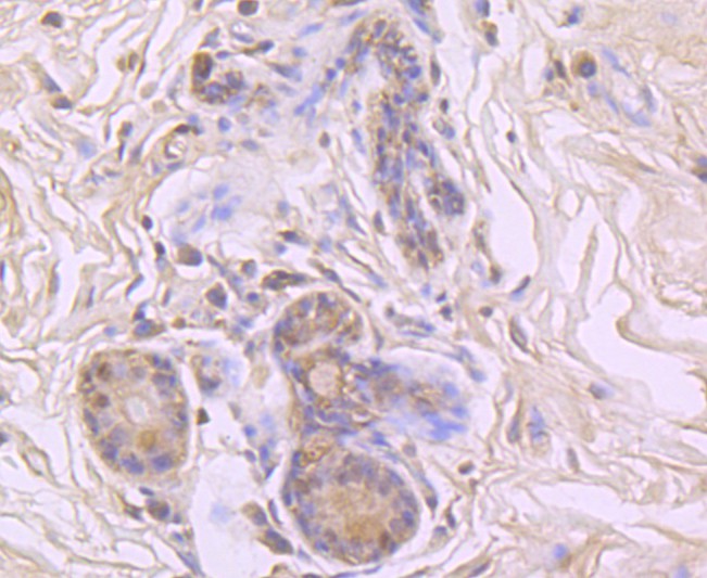 Immunohistochemical analysis of paraffin-embedded human breast carcinoma tissue using anti-Cyclophilin A antibody. The section was pre-treated using heat mediated antigen retrieval with Tris-EDTA buffer (pH 9.0) for 20 minutes.The tissues were blocked in 1% BSA for 30 minutes at room temperature, washed with ddH2O and PBS, and then probed with the primary antibody (ET1703-33, 1/50) for 30 minutes at room temperature. The detection was performed using an HRP conjugated compact polymer system. DAB was used as the chromogen. Tissues were counterstained with hematoxylin and mounted with DPX.