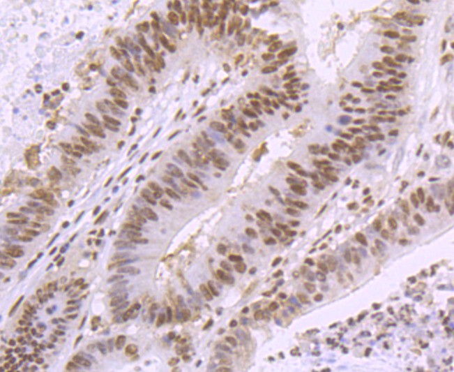 Immunohistochemical analysis of paraffin-embedded human colon cancer tissue using anti-SMC3 antibody. Counter stained with hematoxylin.