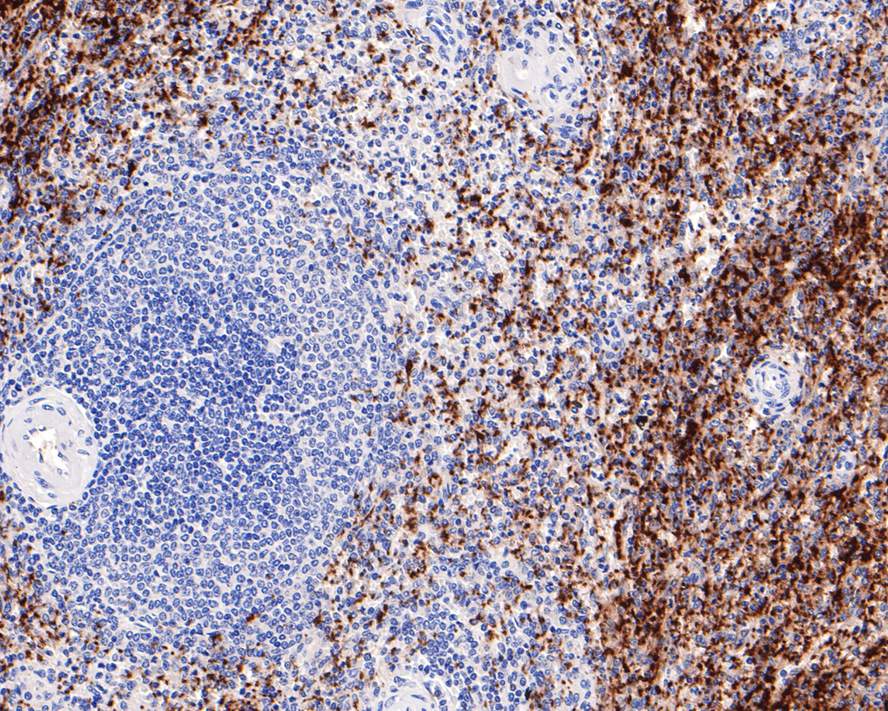 Immunohistochemical analysis of paraffin-embedded human breast carcinoma tissue with Rabbit anti-CD41 antibody (ET1703-37) at 1/100 dilution.<br />
<br />
The section was pre-treated using heat mediated antigen retrieval with Tris-EDTA buffer (pH 9.0) for 20 minutes. The tissues were blocked in 1% BSA for 20 minutes at room temperature, washed with ddH2O and PBS, and then probed with the primary antibody (ET1703-37) at 1/100 dilution for 1 hour at room temperature. The detection was performed using an HRP conjugated compact polymer system. DAB was used as the chromogen. Tissues were counterstained with hematoxylin and mounted with DPX.