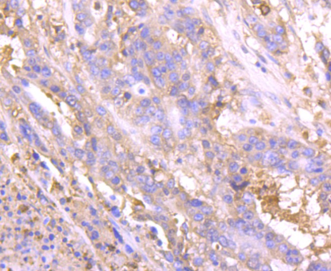 Immunohistochemical analysis of paraffin-embedded human stomach carcinoma tissue using anti-Lipocalin-2 antibody. The section was pre-treated using heat mediated antigen retrieval with Tris-EDTA buffer (pH 9.0) for 20 minutes.The tissues were blocked in 1% BSA for 30 minutes at room temperature, washed with ddH2O and PBS, and then probed with the primary antibody (ET1703-39, 1/50) for 30 minutes at room temperature. The detection was performed using an HRP conjugated compact polymer system. DAB was used as the chromogen. Tissues were counterstained with hematoxylin and mounted with DPX.