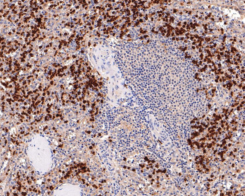 Immunohistochemical analysis of paraffin-embedded human spleen tissue with Rabbit anti-Lipocalin-2 antibody (ET1703-39) at 1/400 dilution.<br />
<br />
The section was pre-treated using heat mediated antigen retrieval with Tris-EDTA buffer (pH 9.0) for 20 minutes. The tissues were blocked in 1% BSA for 20 minutes at room temperature, washed with ddH2O and PBS, and then probed with the primary antibody (ET1703-39) at 1/400 dilution for 1 hour at room temperature. The detection was performed using an HRP conjugated compact polymer system. DAB was used as the chromogen. Tissues were counterstained with hematoxylin and mounted with DPX.