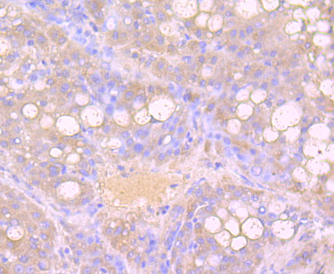 Immunohistochemical analysis of paraffin-embedded human liver carcinoma tissue using anti-Growth Hormone antibody. The section was pre-treated using heat mediated antigen retrieval with Tris-EDTA buffer (pH 9.0) for 20 minutes.The tissues were blocked in 1% BSA for 30 minutes at room temperature, washed with ddH2O and PBS, and then probed with the primary antibody (ET1703-47, 1/50) for 30 minutes at room temperature. The detection was performed using an HRP conjugated compact polymer system. DAB was used as the chromogen. Tissues were counterstained with hematoxylin and mounted with DPX.