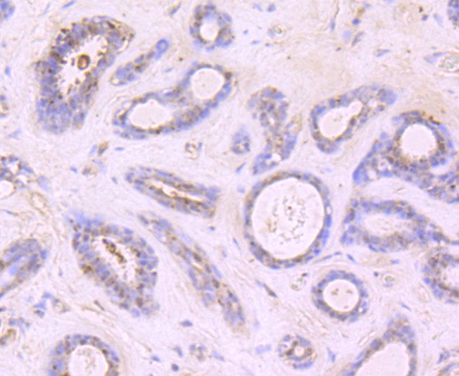 Immunohistochemical analysis of paraffin-embedded human breast carcinoma tissue using anti-Growth Hormone antibody. The section was pre-treated using heat mediated antigen retrieval with Tris-EDTA buffer (pH 9.0) for 20 minutes.The tissues were blocked in 1% BSA for 30 minutes at room temperature, washed with ddH2O and PBS, and then probed with the primary antibody (ET1703-47, 1/50) for 30 minutes at room temperature. The detection was performed using an HRP conjugated compact polymer system. DAB was used as the chromogen. Tissues were counterstained with hematoxylin and mounted with DPX.