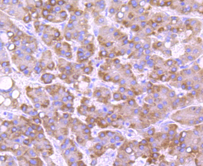 Immunohistochemical analysis of paraffin-embedded human liver carcinoma tissue using anti-CYP2E1 antibody. The section was pre-treated using heat mediated antigen retrieval with Tris-EDTA buffer (pH 8.0-8.4) for 20 minutes.The tissues were blocked in 5% BSA for 30 minutes at room temperature, washed with ddH2O and PBS, and then probed with the primary antibody (ET1703-48, 1/50) for 30 minutes at room temperature. The detection was performed using an HRP conjugated compact polymer system. DAB was used as the chromogen. Tissues were counterstained with hematoxylin and mounted with DPX.