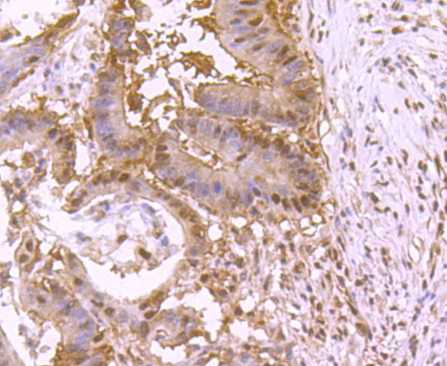 Immunohistochemical analysis of paraffin-embedded human colon carcinoma tissue using anti-VCP antibody. The section was pre-treated using heat mediated antigen retrieval with Tris-EDTA buffer (pH 8.0-8.4) for 20 minutes.The tissues were blocked in 5% BSA for 30 minutes at room temperature, washed with ddH2O and PBS, and then probed with the primary antibody (ET1703-56, 1/50) for 30 minutes at room temperature. The detection was performed using an HRP conjugated compact polymer system. DAB was used as the chromogen. Tissues were counterstained with hematoxylin and mounted with DPX.