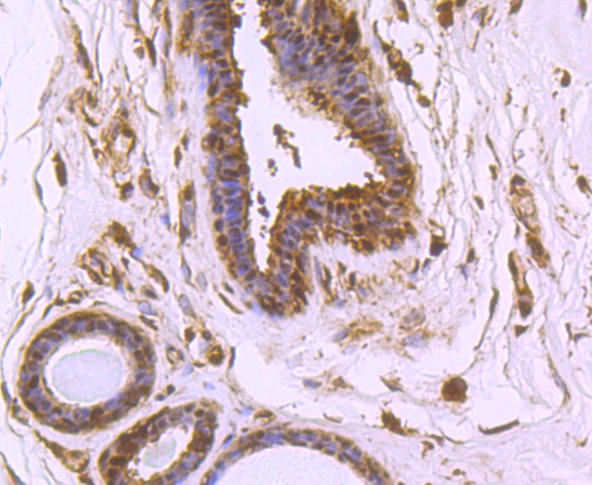 Immunohistochemical analysis of paraffin-embedded human breast carcinoma tissue using anti-VCP antibody. The section was pre-treated using heat mediated antigen retrieval with Tris-EDTA buffer (pH 8.0-8.4) for 20 minutes.The tissues were blocked in 5% BSA for 30 minutes at room temperature, washed with ddH2O and PBS, and then probed with the primary antibody (ET1703-56, 1/50) for 30 minutes at room temperature. The detection was performed using an HRP conjugated compact polymer system. DAB was used as the chromogen. Tissues were counterstained with hematoxylin and mounted with DPX.