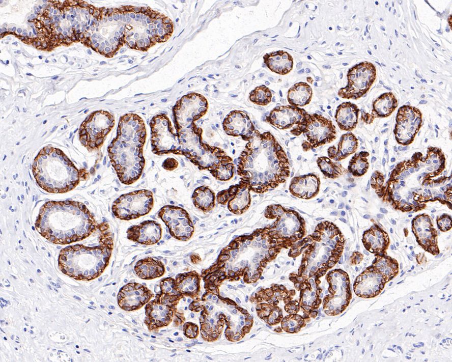 Immunohistochemical analysis of paraffin-embedded human colon carcinoma tissue using anti-Podoplanin antibody. The section was pre-treated using heat mediated antigen retrieval with Tris-EDTA buffer (pH 9.0) for 20 minutes.The tissues were blocked in 1% BSA for 30 minutes at room temperature, washed with ddH2O and PBS, and then probed with the primary antibody (ET1703-61, 1/50) for 30 minutes at room temperature. The detection was performed using an HRP conjugated compact polymer system. DAB was used as the chromogen. Tissues were counterstained with hematoxylin and mounted with DPX.