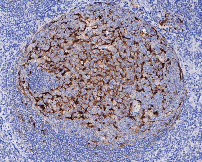 Immunohistochemical analysis of paraffin-embedded human tonsils tissue with Rabbit anti-S100 alpha antibody (ET1703-72) at 1/200 dilution.<br />
<br />
The section was pre-treated using heat mediated antigen retrieval with Tris-EDTA buffer (pH 9.0) for 20 minutes. The tissues were blocked in 1% BSA for 20 minutes at room temperature, washed with ddH2O and PBS, and then probed with the primary antibody (ET1703-72) at 1/200 dilution for 1 hour at room temperature. The detection was performed using an HRP conjugated compact polymer system. DAB was used as the chromogen. Tissues were counterstained with hematoxylin and mounted with DPX.
