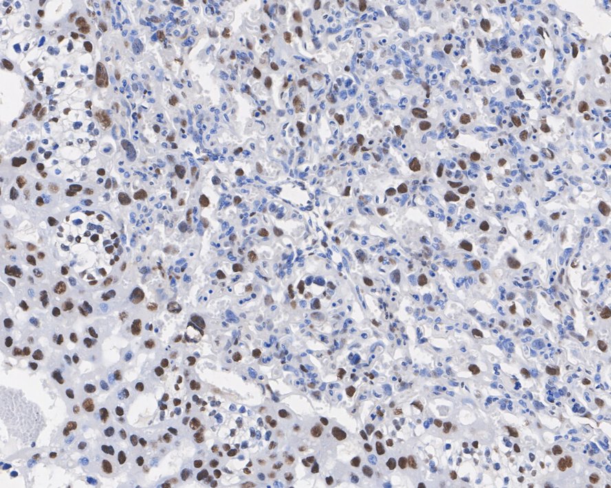 Immunohistochemical analysis of paraffin-embedded human spleen tissue using anti-TDP43 antibody. The section was pre-treated using heat mediated antigen retrieval with Tris-EDTA buffer (pH 8.0-8.4) for 20 minutes.The tissues were blocked in 5% BSA for 30 minutes at room temperature, washed with ddH2O and PBS, and then probed with the primary antibody (ET1703-74, 1/50) for 30 minutes at room temperature. The detection was performed using an HRP conjugated compact polymer system. DAB was used as the chromogen. Tissues were counterstained with hematoxylin and mounted with DPX.