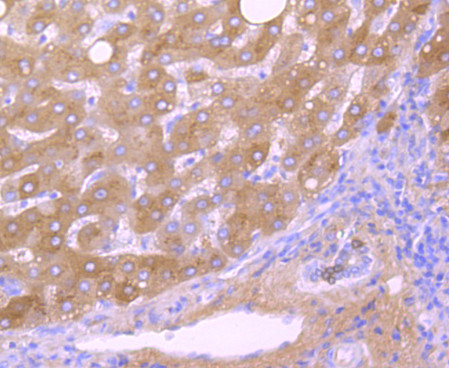 Immunohistochemical analysis of paraffin-embedded human liver carcinoma tissue using anti-TTR antibody. The section was pre-treated using heat mediated antigen retrieval with Tris-EDTA buffer (pH 8.0-8.4) for 20 minutes.The tissues were blocked in 5% BSA for 30 minutes at room temperature, washed with ddH2O and PBS, and then probed with the primary antibody (ET1703-83, 1/50) for 30 minutes at room temperature. The detection was performed using an HRP conjugated compact polymer system. DAB was used as the chromogen. Tissues were counterstained with hematoxylin and mounted with DPX.