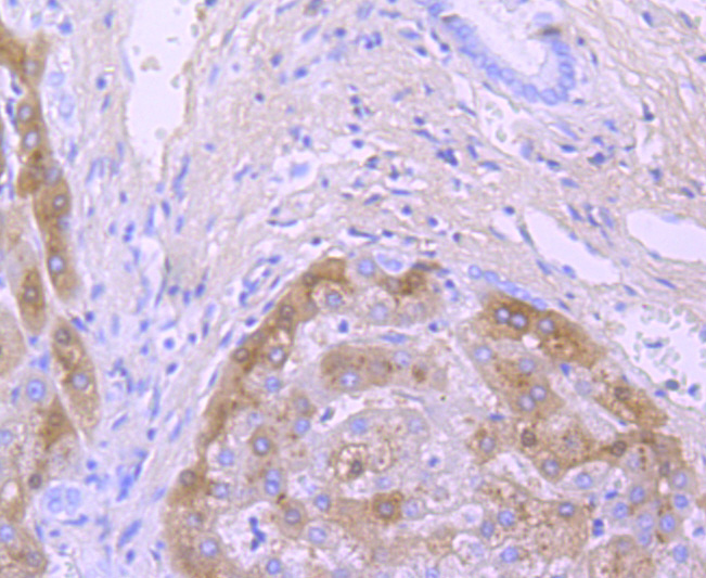 Immunohistochemical analysis of paraffin-embedded human liver tissue using anti-TTR antibody. The section was pre-treated using heat mediated antigen retrieval with Tris-EDTA buffer (pH 8.0-8.4) for 20 minutes.The tissues were blocked in 5% BSA for 30 minutes at room temperature, washed with ddH2O and PBS, and then probed with the primary antibody (ET1703-83, 1/50) for 30 minutes at room temperature. The detection was performed using an HRP conjugated compact polymer system. DAB was used as the chromogen. Tissues were counterstained with hematoxylin and mounted with DPX.