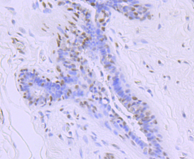 Immunohistochemical analysis of paraffin-embedded human breast carcinoma tissue using anti-Phospho-POLR2A (S5) antibody. The section was pre-treated using heat mediated antigen retrieval with sodium citrate buffer (pH 6.0) for 20 minutes. The tissues were blocked in 1% BSA for 30 minutes at room temperature, washed with ddH2O and PBS, and then probed with the primary antibody (ET1703-87, 1/50)  for 30 minutes at room temperature. The detection was performed using an HRP conjugated compact polymer system. DAB was used as the chromogen. Tissues were counterstained with hematoxylin and mounted with DPX.