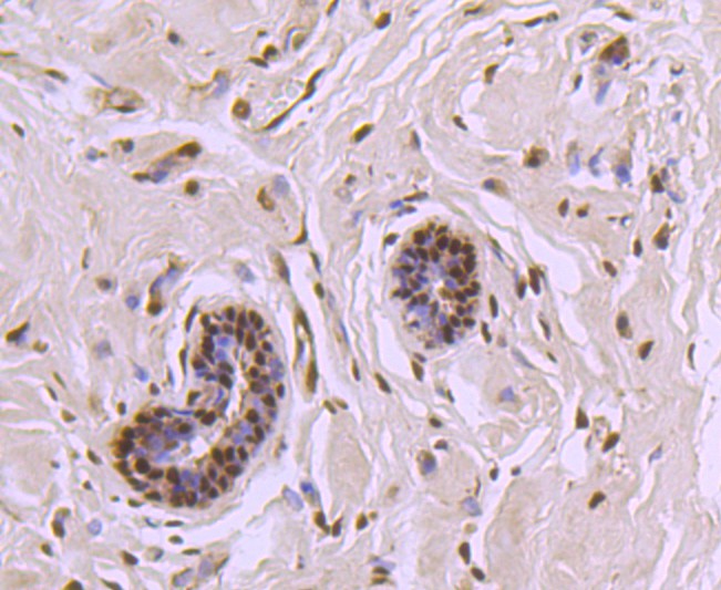 Immunohistochemical analysis of paraffin-embedded human breast carcinoma tissue using anti-CTCF antibody. The section was pre-treated using heat mediated antigen retrieval with Tris-EDTA buffer (pH 8.0-8.4) for 20 minutes.The tissues were blocked in 5% BSA for 30 minutes at room temperature, washed with ddH2O and PBS, and then probed with the primary antibody (ET1703-90, 1/50) for 30 minutes at room temperature. The detection was performed using an HRP conjugated compact polymer system. DAB was used as the chromogen. Tissues were counterstained with hematoxylin and mounted with DPX.