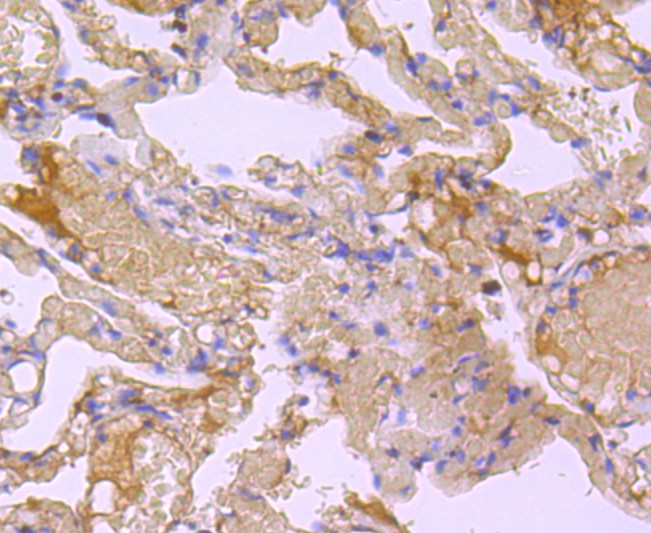 Immunohistochemical analysis of paraffin-embedded human lung tissue with Rabbit anti-Bid antibody (ET1703-92) at 1/50 dilution.Hela cells<br />
The section was pre-treated using heat mediated antigen retrieval with Tris-EDTA buffer (pH 9.0) for 20 minutes. The tissues were blocked in 1% BSA for 20 minutes at room temperature, washed with ddH2O and PBS, and then probed with the primary antibody (ET1703-92) at 1/50 dilution for 1 hour at room temperature. The detection was performed using an HRP conjugated compact polymer system. DAB was used as the chromogen. Tissues were counterstained with hematoxylin and mounted with DPX.