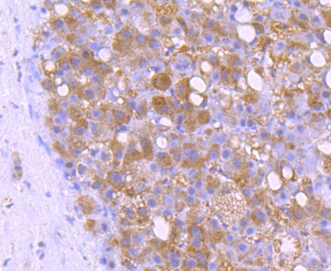 Immunohistochemical analysis of paraffin-embedded human liver cancer tissue with Rabbit anti-Bid antibody (ET1703-92) at 1/50 dilution.Hela cells<br />
The section was pre-treated using heat mediated antigen retrieval with Tris-EDTA buffer (pH 9.0) for 20 minutes. The tissues were blocked in 1% BSA for 20 minutes at room temperature, washed with ddH2O and PBS, and then probed with the primary antibody (ET1703-92) at 1/50 dilution for 1 hour at room temperature. The detection was performed using an HRP conjugated compact polymer system. DAB was used as the chromogen. Tissues were counterstained with hematoxylin and mounted with DPX.