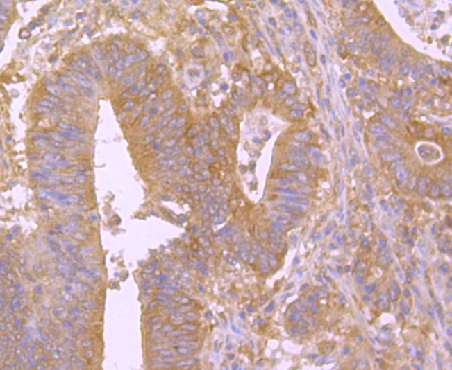 Immunohistochemical analysis of paraffin-embedded human colon cancer tissue with Rabbit anti-Bid antibody (ET1703-92) at 1/50 dilution.Hela cells<br />
The section was pre-treated using heat mediated antigen retrieval with Tris-EDTA buffer (pH 9.0) for 20 minutes. The tissues were blocked in 1% BSA for 20 minutes at room temperature, washed with ddH2O and PBS, and then probed with the primary antibody (ET1703-92) at 1/50 dilution for 1 hour at room temperature. The detection was performed using an HRP conjugated compact polymer system. DAB was used as the chromogen. Tissues were counterstained with hematoxylin and mounted with DPX.