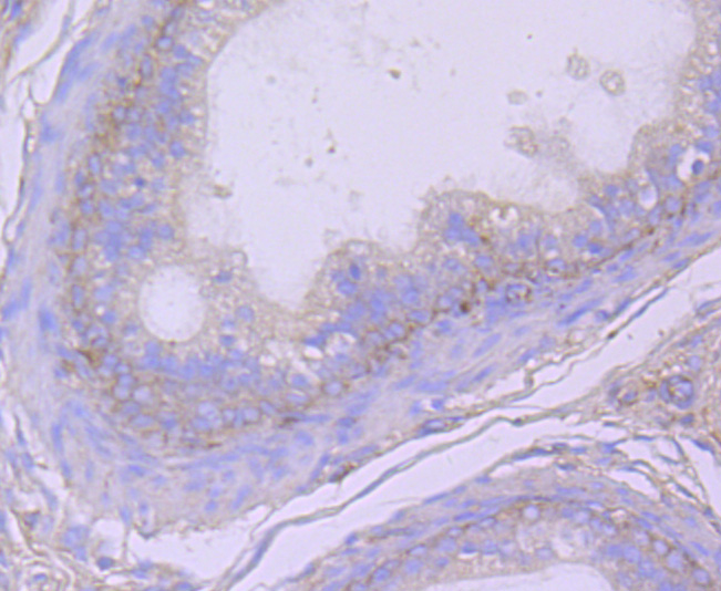 ICC staining of CD26 in PC-12 cells (red). Formalin fixed cells were permeabilized with 0.1% Triton X-100 in TBS for 10 minutes at room temperature and blocked with 1% Blocker BSA for 15 minutes at room temperature. Cells were probed with the primary antibody (ET1703-93, 1/50) for 1 hour at room temperature, washed with PBS. Alexa Fluor®594 Goat anti-Rabbit IgG was used as the secondary antibody at 1/1,000 dilution. The nuclear counter stain is DAPI (blue).