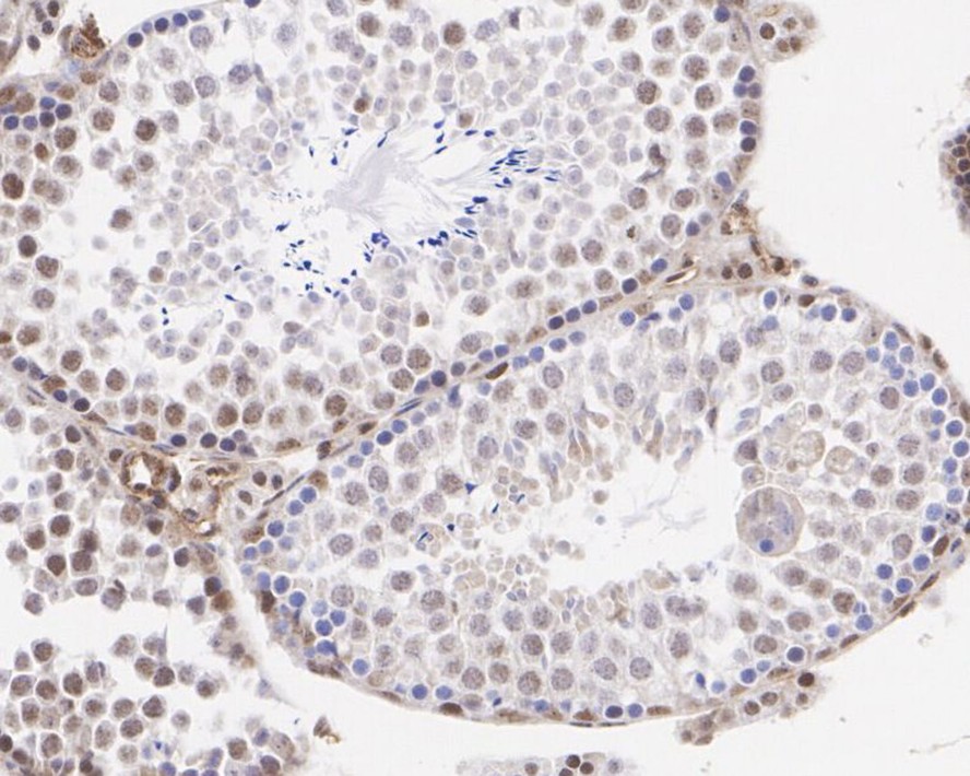 Immunohistochemical analysis of paraffin-embedded human colon carcinoma tissue with Rabbit anti-NUR77 antibody (ET1703-97) at 1/1,000 dilution.<br />
<br />
The section was pre-treated using heat mediated antigen retrieval with sodium citrate buffer (pH 6.0) for 2 minutes. The tissues were blocked in 1% BSA for 20 minutes at room temperature, washed with ddH2O and PBS, and then probed with the primary antibody (ET1703-97) at 1/1,000 dilution for 1 hour at room temperature. The detection was performed using an HRP conjugated compact polymer system. DAB was used as the chromogen. Tissues were counterstained with hematoxylin and mounted with DPX.