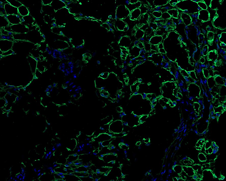 ICC staining of FABP4 in A549 cells (red). Formalin fixed cells were permeabilized with 0.1% Triton X-100 in TBS for 10 minutes at room temperature and blocked with 10% negative goat serum for 15 minutes at room temperature. Cells were probed with the primary antibody (ET1703-98, 1/50) for 1 hour at room temperature, washed with PBS. Alexa Fluor®594 conjugate-Goat anti-Rabbit IgG was used as the secondary antibody at 1/1,000 dilution. The nuclear counter stain is DAPI (blue).