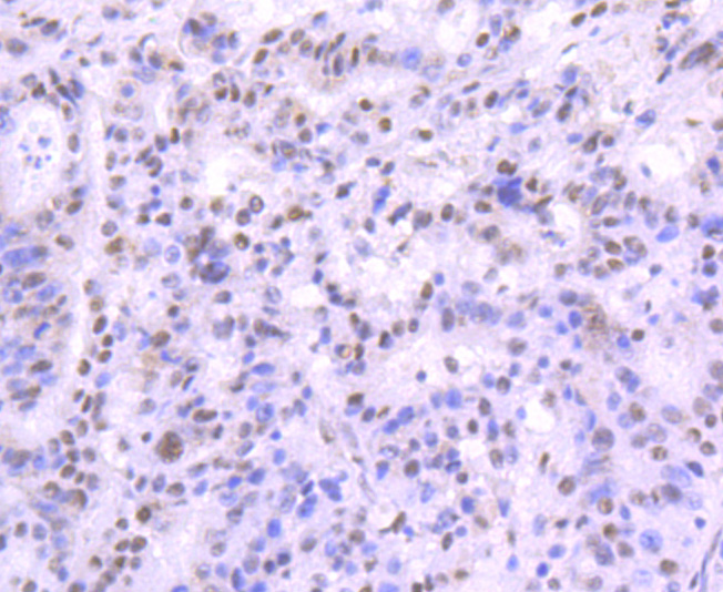 Immunohistochemical analysis of paraffin-embedded human stomach cancer tissue using anti- Mre11 antibody. Counter stained with hematoxylin.