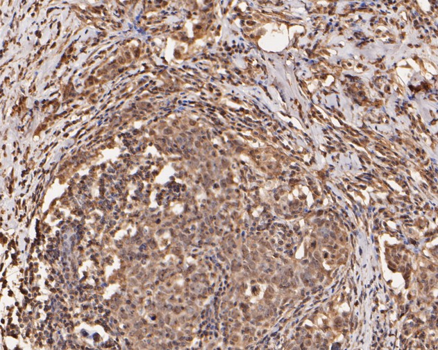 Immunohistochemical analysis of paraffin-embedded human breast infiltrating duct carcinoma tissue using anti-XRCC1 antibody. The section was pre-treated using heat mediated antigen retrieval with sodium citrate buffer (pH 6.0) for 20 minutes. The tissues were blocked in 5% BSA for 30 minutes at room temperature, washed with ddH2O and PBS, and then probed with the primary antibody (ET1704-01, 1/50)  for 30 minutes at room temperature. The detection was performed using an HRP conjugated compact polymer system. DAB was used as the chromogen. Tissues were counterstained with hematoxylin and mounted with DPX.