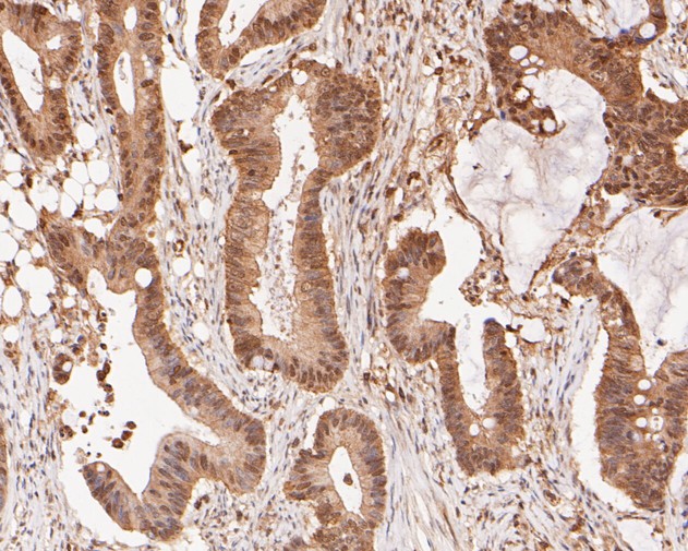 Immunohistochemical analysis of paraffin-embedded human colon carcinoma tissue using anti-XRCC1 antibody. The section was pre-treated using heat mediated antigen retrieval with sodium citrate buffer (pH 6.0) for 20 minutes. The tissues were blocked in 5% BSA for 30 minutes at room temperature, washed with ddH2O and PBS, and then probed with the primary antibody (ET1704-01, 1/50)  for 30 minutes at room temperature. The detection was performed using an HRP conjugated compact polymer system. DAB was used as the chromogen. Tissues were counterstained with hematoxylin and mounted with DPX.