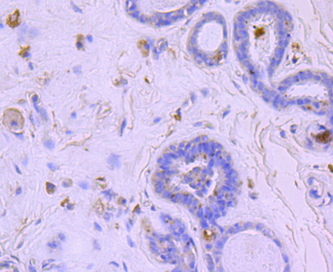 Immunohistochemical analysis of paraffin-embedded human breast carcinoma tissue using anti-BNIP3 antibody. The section was pre-treated using heat mediated antigen retrieval with Tris-EDTA buffer (pH 8.0-8.4) for 20 minutes.The tissues were blocked in 5% BSA for 30 minutes at room temperature, washed with ddH2O and PBS, and then probed with the primary antibody (ET1704-08, 1/50) for 30 minutes at room temperature. The detection was performed using an HRP conjugated compact polymer system. DAB was used as the chromogen. Tissues were counterstained with hematoxylin and mounted with DPX.