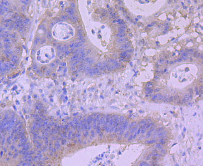 Immunohistochemical analysis of paraffin-embedded human colon carcinoma tissue using anti-BNIP3 antibody. The section was pre-treated using heat mediated antigen retrieval with Tris-EDTA buffer (pH 8.0-8.4) for 20 minutes.The tissues were blocked in 5% BSA for 30 minutes at room temperature, washed with ddH2O and PBS, and then probed with the primary antibody (ET1704-08, 1/50) for 30 minutes at room temperature. The detection was performed using an HRP conjugated compact polymer system. DAB was used as the chromogen. Tissues were counterstained with hematoxylin and mounted with DPX.