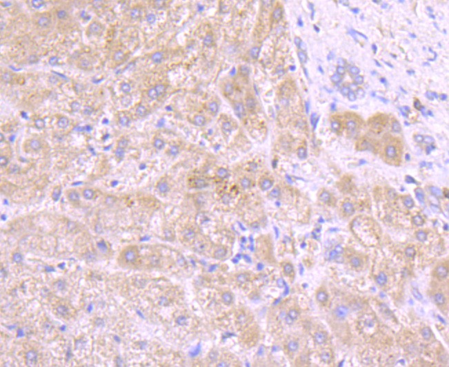 Immunohistochemical analysis of paraffin-embedded human liver tissue using anti-Tyrosinase antibody. The section was pre-treated using heat mediated antigen retrieval with Tris-EDTA buffer (pH 8.0-8.4) for 20 minutes.The tissues were blocked in 5% BSA for 30 minutes at room temperature, washed with ddH2O and PBS, and then probed with the primary antibody (ET1704-18, 1/50) for 30 minutes at room temperature. The detection was performed using an HRP conjugated compact polymer system. DAB was used as the chromogen. Tissues were counterstained with hematoxylin and mounted with DPX.