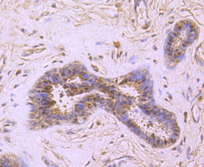 Immunohistochemical analysis of paraffin-embedded human breast carcinoma tissue using anti-PRMT1 antibody. The section was pre-treated using heat mediated antigen retrieval with Tris-EDTA buffer (pH 8.0-8.4) for 20 minutes.The tissues were blocked in 5% BSA for 30 minutes at room temperature, washed with ddH2O and PBS, and then probed with the primary antibody (ET1704-19, 1/50) for 30 minutes at room temperature. The detection was performed using an HRP conjugated compact polymer system. DAB was used as the chromogen. Tissues were counterstained with hematoxylin and mounted with DPX.