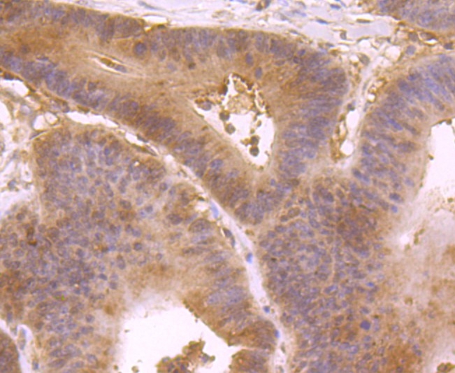 Immunohistochemical analysis of paraffin-embedded human colon carcinoma tissue using anti-IL4 antibody. The section was pre-treated using heat mediated antigen retrieval with Tris-EDTA buffer (pH 9.0) for 20 minutes.The tissues were blocked in 1% BSA for 30 minutes at room temperature, washed with ddH2O and PBS, and then probed with the primary antibody (ET1704-28, 1/50) for 30 minutes at room temperature. The detection was performed using an HRP conjugated compact polymer system. DAB was used as the chromogen. Tissues were counterstained with hematoxylin and mounted with DPX.