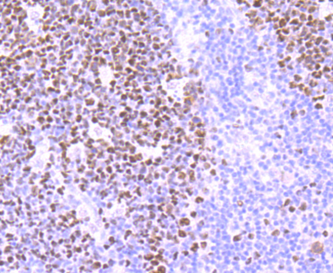 Immunohistochemical analysis of paraffin-embedded human lung tissue using anti-MSH6 antibody. Counter stained with hematoxylin.