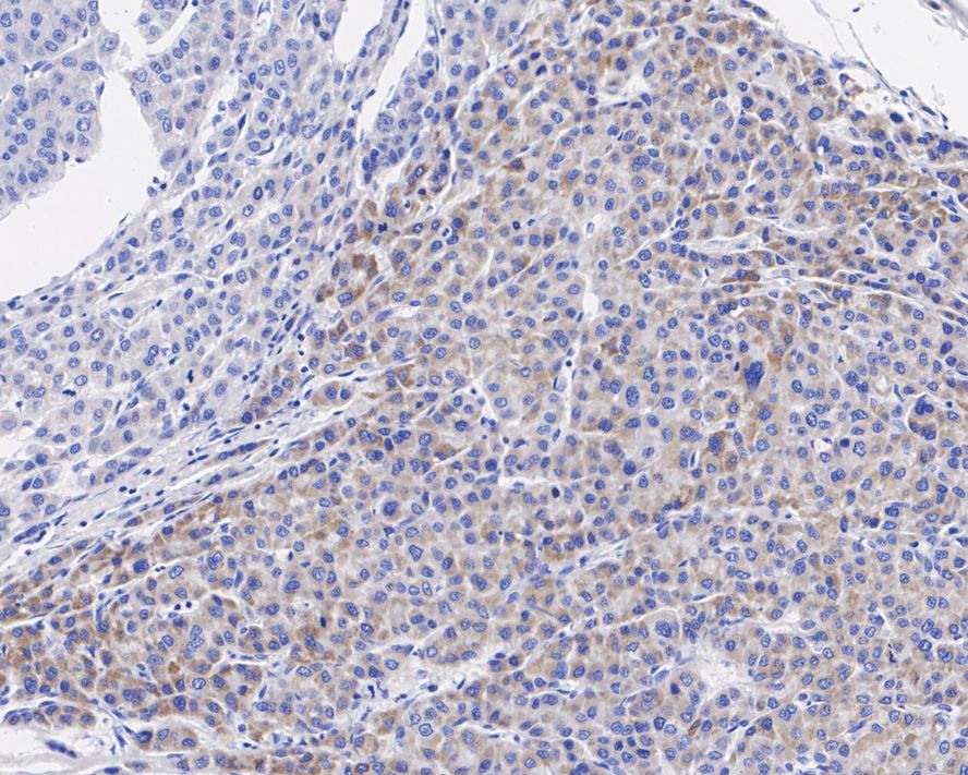 Immunohistochemical analysis of paraffin-embedded human skin tissue with Rabbit anti-EGF antibody (ET1704-33) at 1/50 dilution.<br />
<br />
The section was pre-treated using heat mediated antigen retrieval with Tris-EDTA buffer (pH 9.0) for 20 minutes. The tissues were blocked in 1% BSA for 20 minutes at room temperature, washed with ddH2O and PBS, and then probed with the primary antibody (ET1704-33) at 1/50 dilution for 1 hour at room temperature. The detection was performed using an HRP conjugated compact polymer system. DAB was used as the chromogen. Tissues were counterstained with hematoxylin and mounted with DPX.