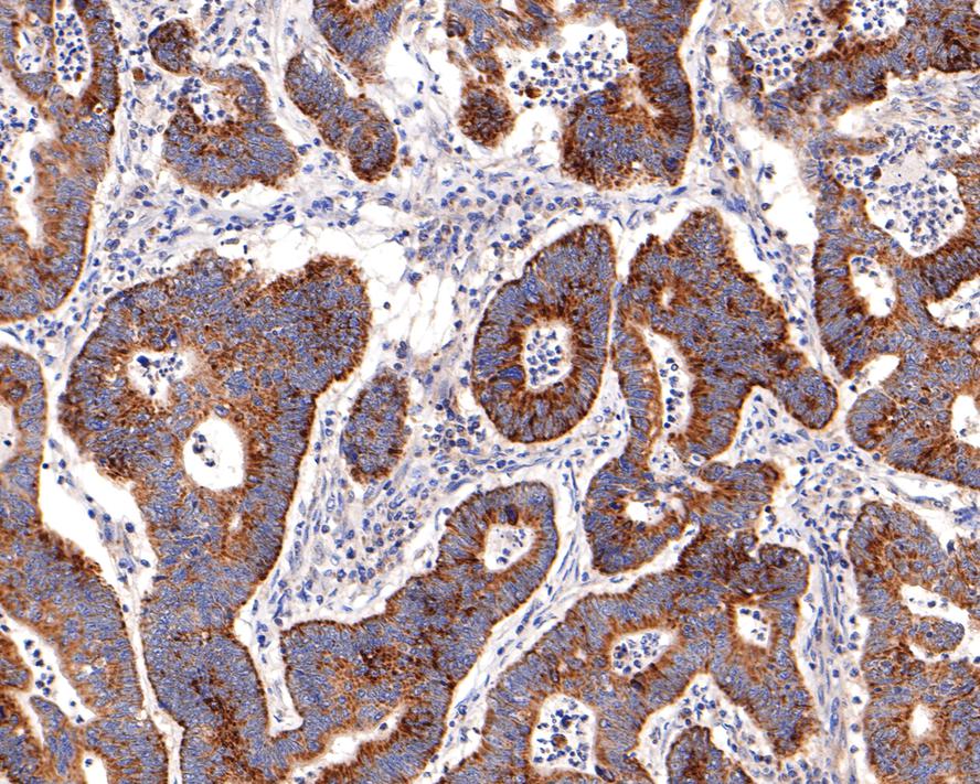 Immunohistochemical analysis of paraffin-embedded human colon carcinoma tissue with Rabbit anti-IKK gamma antibody (ET1704-40) at 1/400 dilution.<br />
<br />
The section was pre-treated using heat mediated antigen retrieval with sodium citrate buffer (pH 6.0) for 2 minutes. The tissues were blocked in 1% BSA for 20 minutes at room temperature, washed with ddH2O and PBS, and then probed with the primary antibody (ET1704-40) at 1/400 dilution for 1 hour at room temperature. The detection was performed using an HRP conjugated compact polymer system. DAB was used as the chromogen. Tissues were counterstained with hematoxylin and mounted with DPX.