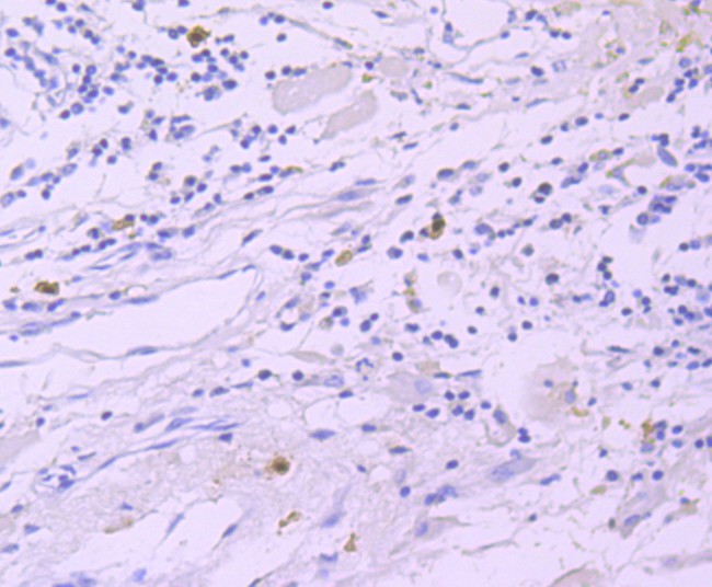 Immunohistochemical analysis of paraffin-embedded human breast carcinoma tissue using anti-GATA1 antibody. The section was pre-treated using heat mediated antigen retrieval with Tris-EDTA buffer (pH 9.0) for 20 minutes.The tissues were blocked in 5% BSA for 30 minutes at room temperature, washed with ddH2O and PBS, and then probed with the primary antibody (ET1704-41, 1/50) for 30 minutes at room temperature. The detection was performed using an HRP conjugated compact polymer system. DAB was used as the chromogen. Tissues were counterstained with hematoxylin and mounted with DPX.