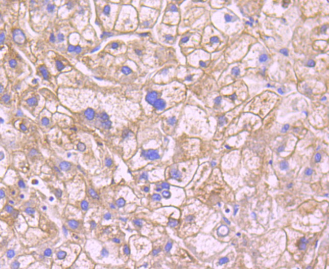 Immunohistochemical analysis of paraffin-embedded human liver carcinoma tissue using anti-Leptin Receptor antibody. The section was pre-treated using heat mediated antigen retrieval with Tris-EDTA buffer (pH 8.0-8.4) for 20 minutes.The tissues were blocked in 5% BSA for 30 minutes at room temperature, washed with ddH2O and PBS, and then probed with the primary antibody (ET1704-44, 1/50) for 30 minutes at room temperature. The detection was performed using an HRP conjugated compact polymer system. DAB was used as the chromogen. Tissues were counterstained with hematoxylin and mounted with DPX.