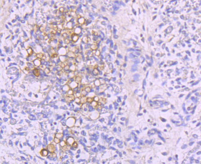 Immunohistochemical analysis of paraffin-embedded human thymus tissue using anti-NFAT2 antibody. The section was pre-treated using heat mediated antigen retrieval with Tris-EDTA buffer (pH 8.0-8.4) for 20 minutes.The tissues were blocked in 5% BSA for 30 minutes at room temperature, washed with ddH2O and PBS, and then probed with the primary antibody (ET1704-45, 1/50) for 30 minutes at room temperature. The detection was performed using an HRP conjugated compact polymer system. DAB was used as the chromogen. Tissues were counterstained with hematoxylin and mounted with DPX.