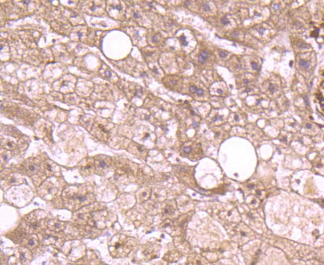 Immunohistochemical analysis of paraffin-embedded human colon carcinoma tissue using anti-Annexin A2 antibody. The section was pre-treated using heat mediated antigen retrieval with Tris-EDTA buffer (pH 8.0-8.4) for 20 minutes.The tissues were blocked in 5% BSA for 30 minutes at room temperature, washed with ddH2O and PBS, and then probed with the primary antibody (ET1704-49, 1/50) for 30 minutes at room temperature. The detection was performed using an HRP conjugated compact polymer system. DAB was used as the chromogen. Tissues were counterstained with hematoxylin and mounted with DPX.