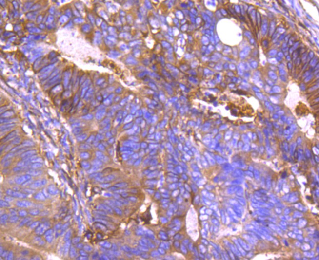 Immunohistochemical analysis of paraffin-embedded human prostate tissue using anti-Annexin A2 antibody. The section was pre-treated using heat mediated antigen retrieval with Tris-EDTA buffer (pH 8.0-8.4) for 20 minutes.The tissues were blocked in 5% BSA for 30 minutes at room temperature, washed with ddH2O and PBS, and then probed with the primary antibody (ET1704-49, 1/50) for 30 minutes at room temperature. The detection was performed using an HRP conjugated compact polymer system. DAB was used as the chromogen. Tissues were counterstained with hematoxylin and mounted with DPX.