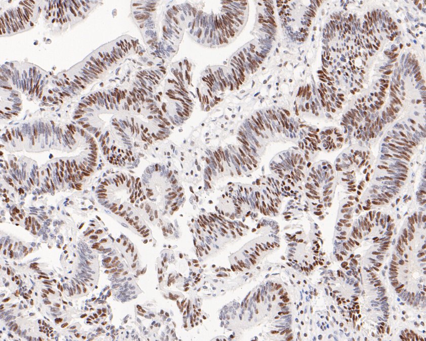 Immunohistochemical analysis of paraffin-embedded human colon carcinoma tissue using anti-hnRNP A1 antibody. The section was pre-treated using heat mediated antigen retrieval with sodium citrate buffer (pH 6.0) for 20 minutes. The tissues were blocked in 5% BSA for 30 minutes at room temperature, washed with ddH2O and PBS, and then probed with the primary antibody (ET1704-52, 1/200)  for 30 minutes at room temperature. The detection was performed using an HRP conjugated compact polymer system. DAB was used as the chromogen. Tissues were counterstained with hematoxylin and mounted with DPX.