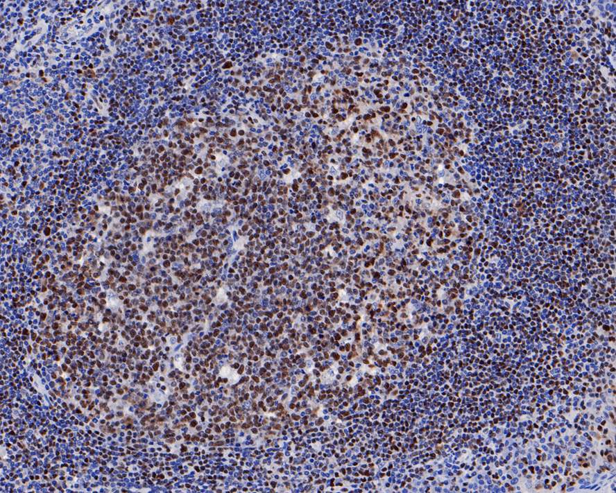 Immunohistochemical analysis of paraffin-embedded human tonsil tissue with Rabbit anti-MEF2A antibody (ET1704-58) at 1/200 dilution.<br />
<br />
The section was pre-treated using heat mediated antigen retrieval with sodium citrate buffer (pH 6.0) for 2 minutes. The tissues were blocked in 1% BSA for 20 minutes at room temperature, washed with ddH2O and PBS, and then probed with the primary antibody (ET1704-58) at 1/200 dilution for 1 hour at room temperature. The detection was performed using an HRP conjugated compact polymer system. DAB was used as the chromogen. Tissues were counterstained with hematoxylin and mounted with DPX.