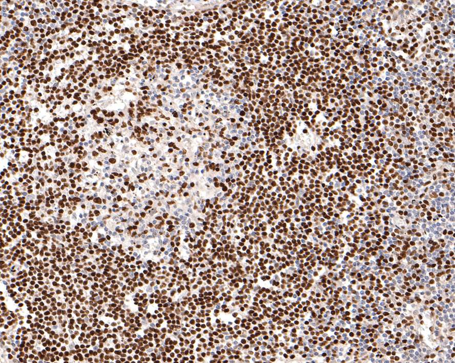 Immunohistochemical analysis of paraffin-embedded human lymph nodes tissue with Rabbit anti-MEF2A antibody (ET1704-58) at 1/500 dilution.<br />
<br />
The section was pre-treated using heat mediated antigen retrieval with sodium citrate buffer (pH 6.0) for 2 minutes. The tissues were blocked in 1% BSA for 20 minutes at room temperature, washed with ddH2O and PBS, and then probed with the primary antibody (ET1704-58) at 1/500 dilution for 1 hour at room temperature. The detection was performed using an HRP conjugated compact polymer system. DAB was used as the chromogen. Tissues were counterstained with hematoxylin and mounted with DPX.