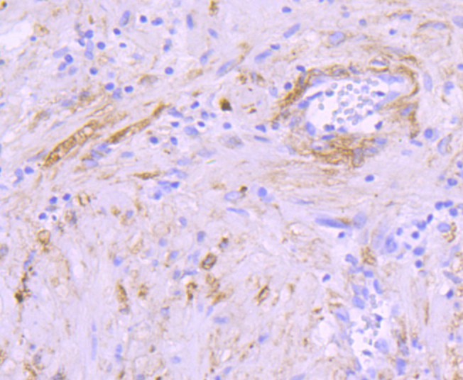 Immunohistochemical analysis of paraffin-embedded human prostate tissue using anti-Alpha B Crystallin antibody. The section was pre-treated using heat mediated antigen retrieval with Tris-EDTA buffer (pH 9.0) for 20 minutes.The tissues were blocked in 5% BSA for 30 minutes at room temperature, washed with ddH2O and PBS, and then probed with the primary antibody (ET1704-60, 1/50) for 30 minutes at room temperature. The detection was performed using an HRP conjugated compact polymer system. DAB was used as the chromogen. Tissues were counterstained with hematoxylin and mounted with DPX.