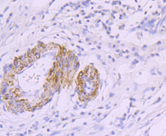 Immunohistochemical analysis of paraffin-embedded human stomach carcinoma tissue using anti-smooth muscle Myosin heavy chain 11 antibody. The section was pre-treated using heat mediated antigen retrieval with Tris-EDTA buffer (pH 8.0-8.4) for 20 minutes.The tissues were blocked in 5% BSA for 30 minutes at room temperature, washed with ddH2O and PBS, and then probed with the primary antibody (ET1704-61, 1/50) for 30 minutes at room temperature. The detection was performed using an HRP conjugated compact polymer system. DAB was used as the chromogen. Tissues were counterstained with hematoxylin and mounted with DPX.