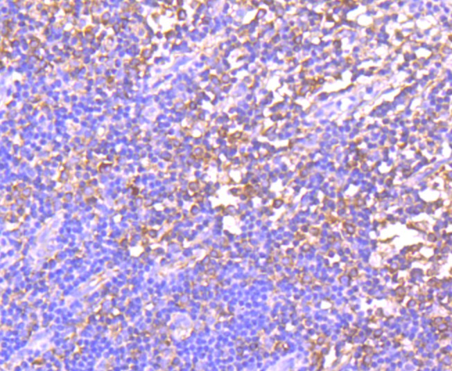 Immunohistochemical analysis of paraffin-embedded human breast carcinoma tissue using anti-GCN2 antibody. The section was pre-treated using heat mediated antigen retrieval with Tris-EDTA buffer (pH 8.0-8.4) for 20 minutes.The tissues were blocked in 5% BSA for 30 minutes at room temperature, washed with ddH2O and PBS, and then probed with the primary antibody (ET1704-68, 1/50) for 30 minutes at room temperature. The detection was performed using an HRP conjugated compact polymer system. DAB was used as the chromogen. Tissues were counterstained with hematoxylin and mounted with DPX.